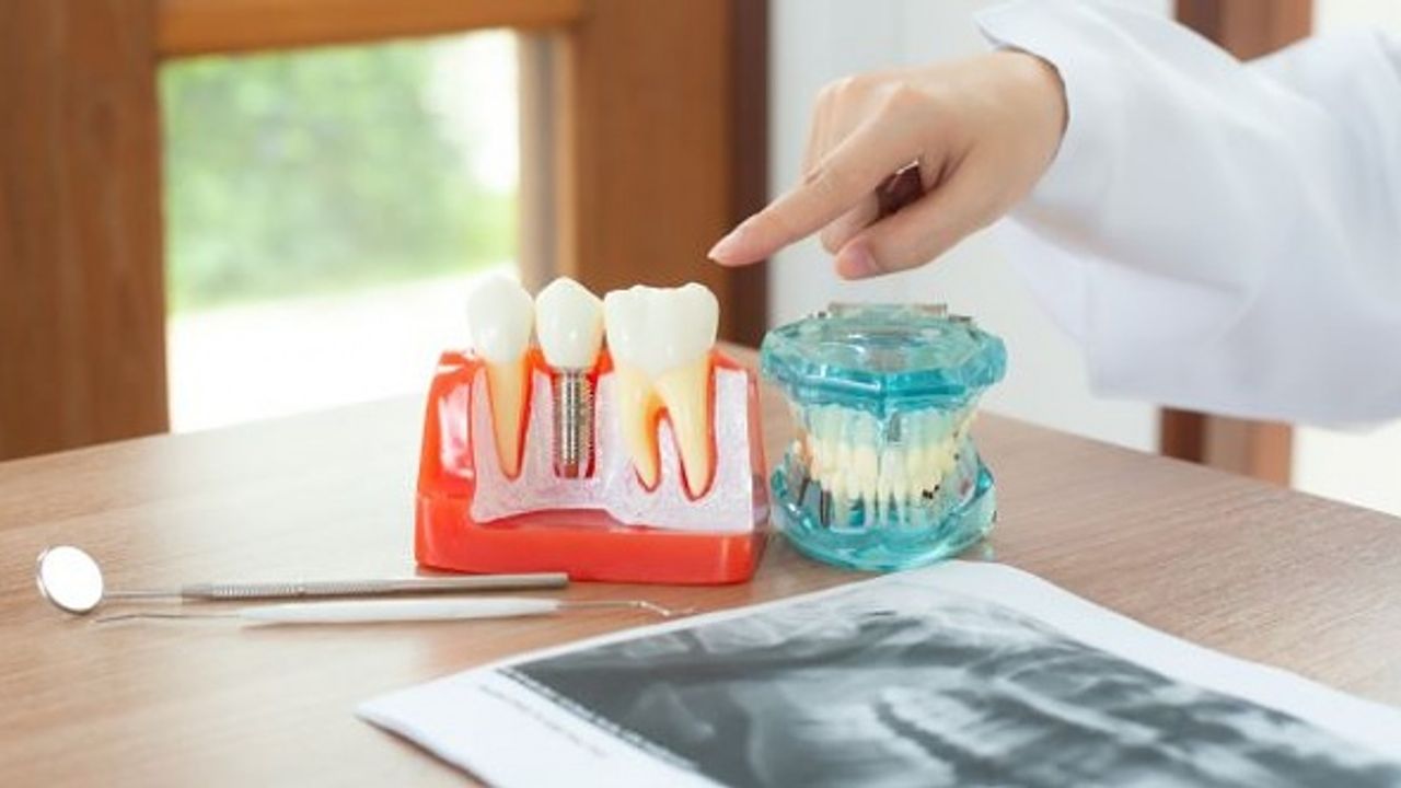 İmplant Diş Tedavisinde Doktor Seçerken Dikkat Edilmesi Gerekenler