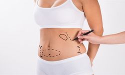 Liposuction Sonuçları Beklentiler ve Gerçekler