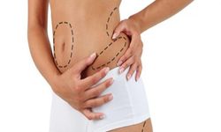 Liposuction Fiyatları Neye Göre Belirleniyor? İşte Detaylar!