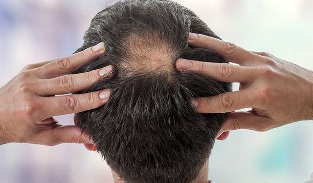 Saç Dökülmesi Neden Olur, Nasıl Tedavi Edilir?