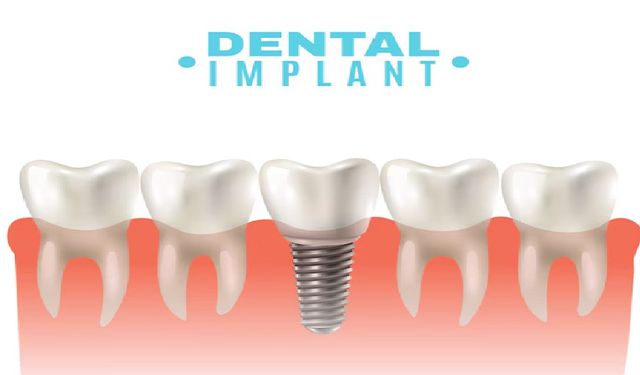 4 Adımda 32 Diş İmplant Fiyatları 2024