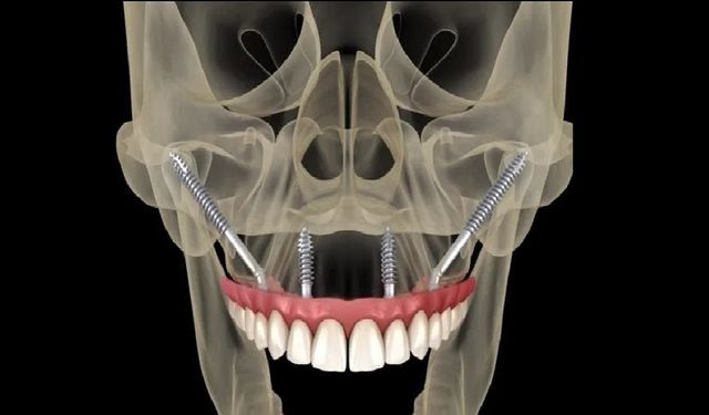 Zigomatik İmplant Nedir? Kimler İçin Uygundur?