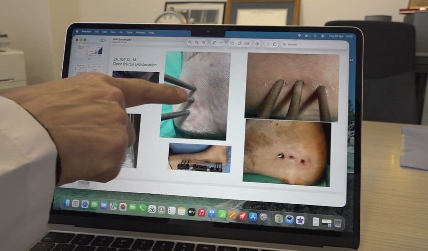 Türk Bilim İnsanlarından Dünyada Bir İlk: Enfeksiyonu Bitiren Yapay Kemik!