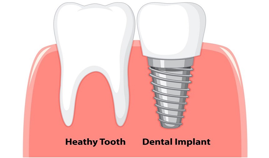 32-dis-implant-fiyatlari-2