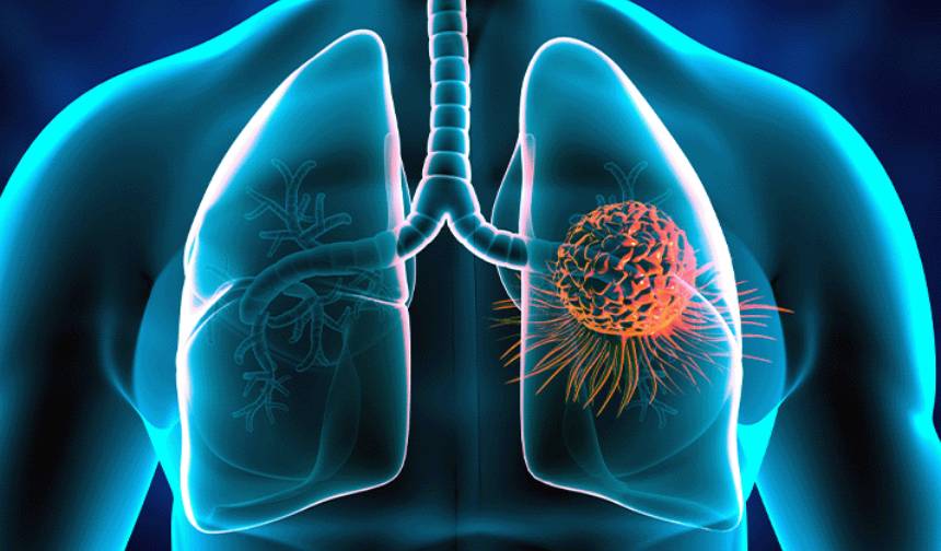Akciger Kanserinin En Sinsi 9 Belirtisi (4)