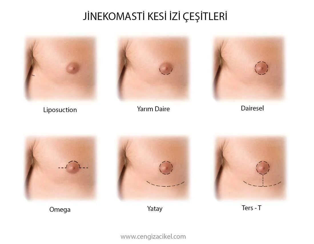 Jinekomasti Kesi Izi Cesitleri.jpg