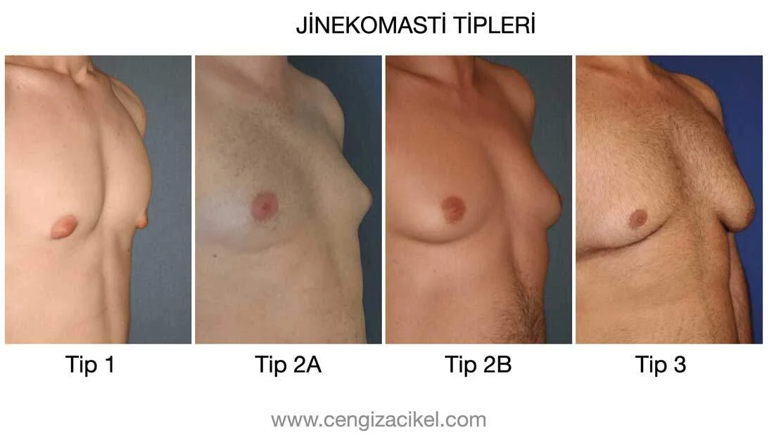 Jinekomasti Tipleri.jpg (1)