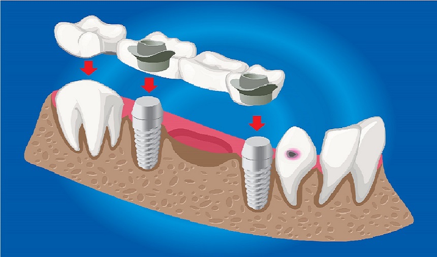 zigomatik-implant-nedir